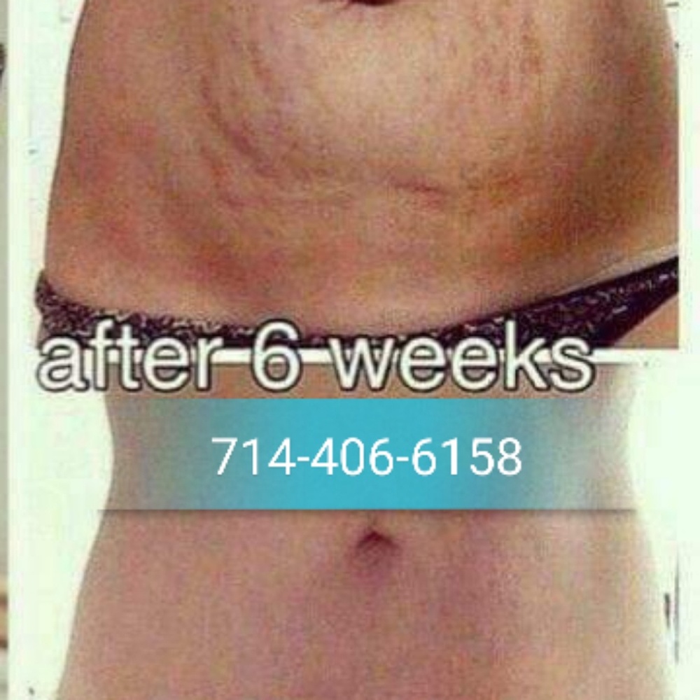 Stretch Mark - dark spot removed